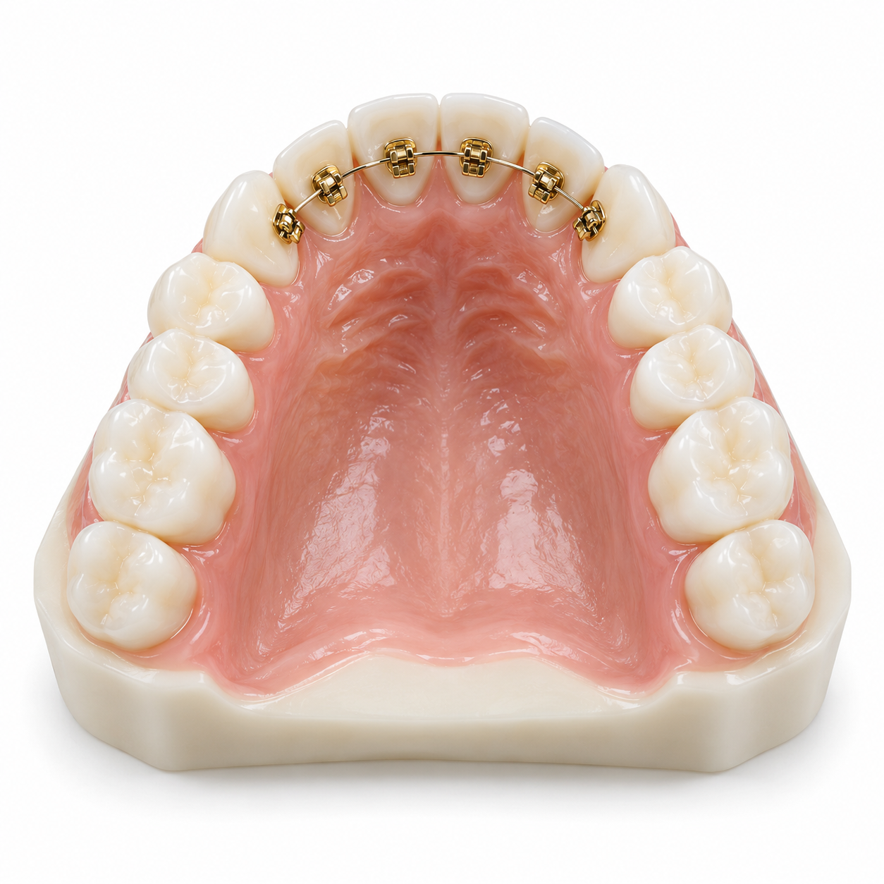 Lingual Invisible Braces